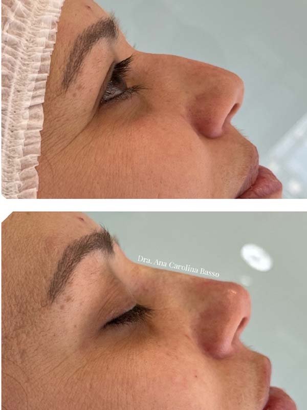 Tratamento estético do nariz com ácido hialurônico, promovendo harmonização facial.