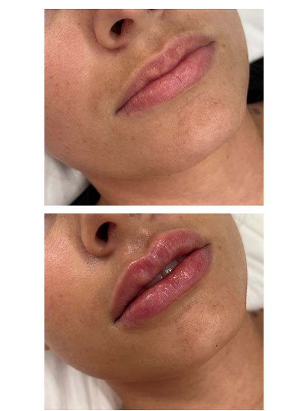 Procedimento estético de preenchimento labial para aumentar o volume dos lábios.