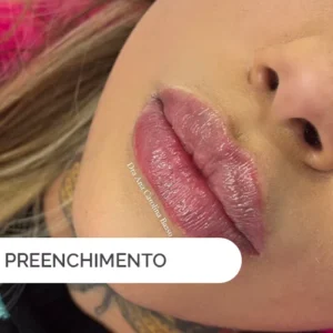 Procedimento estético de preenchimento labial para aumentar o volume dos lábios.