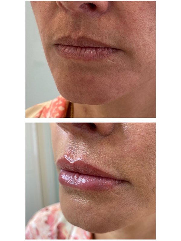 Procedimento estético de preenchimento labial para aumentar o volume dos lábios.