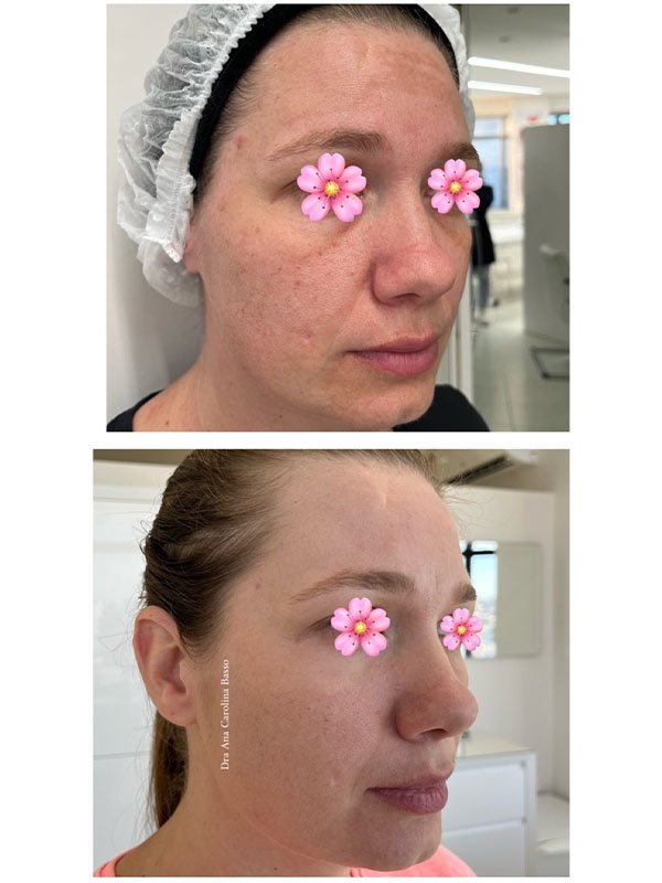 Resultado de antes e depois do tratamento de melasma, com pele visivelmente mais uniforme.